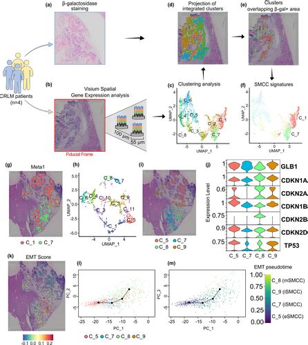 Spatial Resolution Of Cellular Senescence Dynamics In Human Colorectal Liver Metastasis