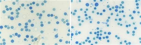 Pictures Of Supravital Stain Showing Increased Reticulocyte Count While