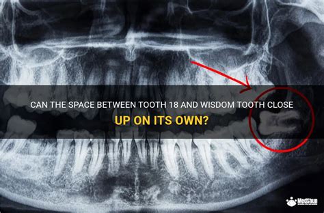 Can The Space Between Tooth 18 And Wisdom Tooth Close Up On Its Own Medshun