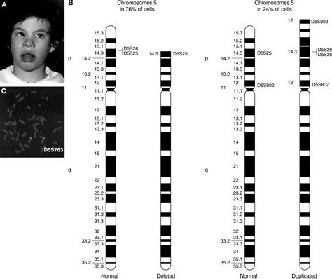 The First Three Mosaic Cri Du Chat Syndrome Patients With Two