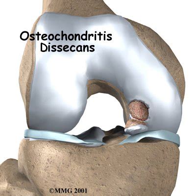 Osteochondritis Dissecans Specialist Clinic Bone Clinic Neurosurgeon