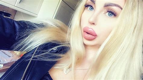 Thursday Plasticsurgery Plasticpositive Plasticlovers Filledwithlove Fillers Lipfillers