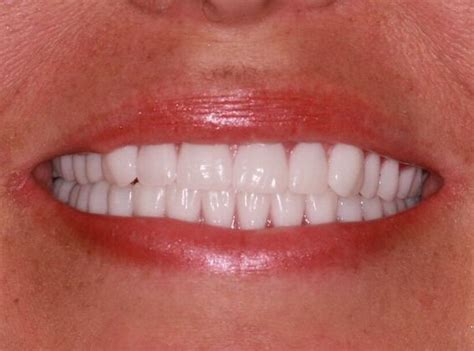 Case 3 Memphis TN Cosmetic Facelift Dentures Before And After