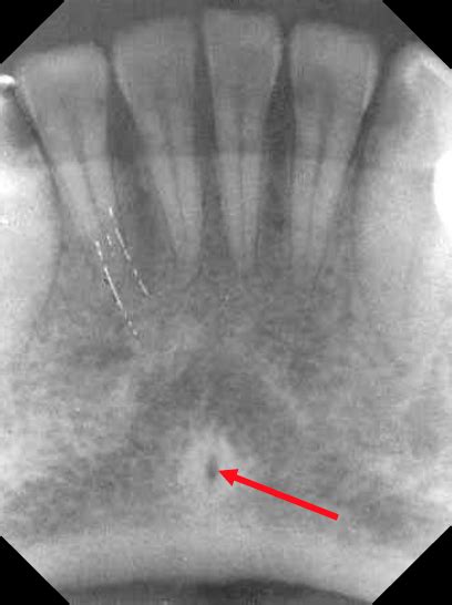 Genial Tubercle Radiograph