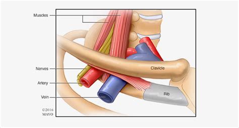 Thoracic Outlet Syndrome Tos Dr Peter Vann