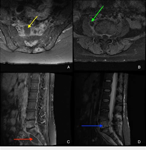 Figure 2 From A Case Of Diffuse Brucellar Spondylodiscitis Semantic