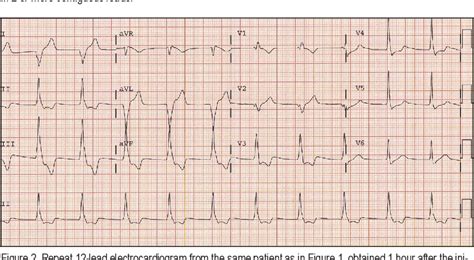 Figure 2 from ECG Diagnosis: Accelerated Idioventricular Rhythm. | Semantic Scholar