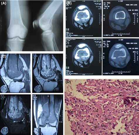 Fludarabine Idarubicin And Cytarabine Regimen Together With Tki