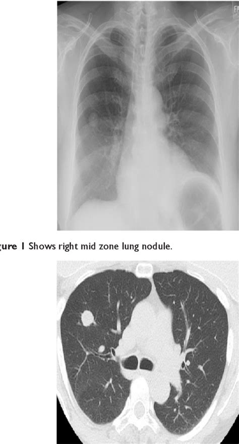 Figure 1 From Sarcoidosis A Rare Cause Of Solitary Pulmonary Nodule