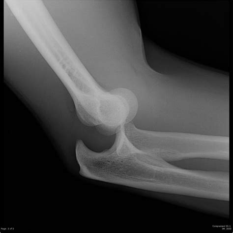 Anterior Vs Posterior Elbow Dislocation