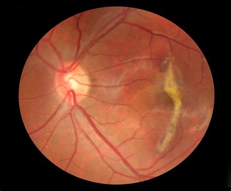 Puckering Of Macula Causes Symptoms And Treatments