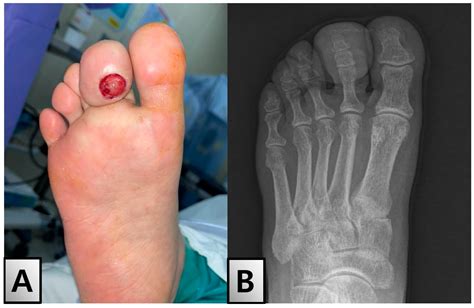 A Rare Case Of Solitary Neurofibroma Misdiagnosed As Diabetic Foot Ulcer In The Toe Tip Region