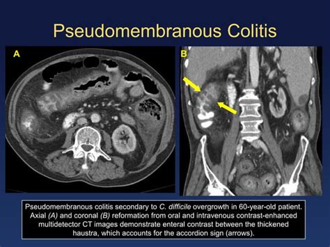 Enteritis And Colitis Ppt