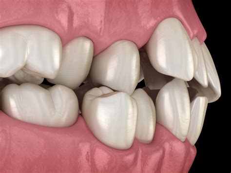 How To Fix Misaligned Teeth