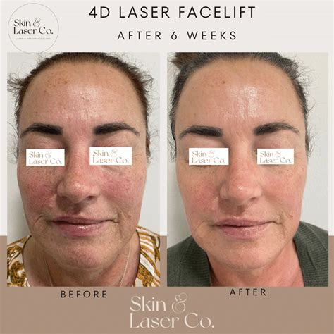 Fotona D Non Surgical Facelift Skin Laser Co