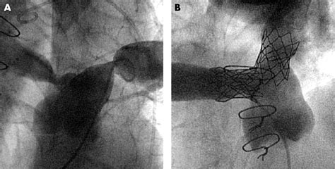 Post Cardiac Surgery care – SujyotHeartClinic