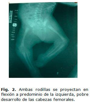 Mily Jess Incidencia Y Causas De La Artrogriposis Multiple Congenita