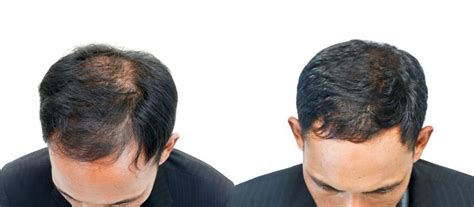 Prp Hair Restoration Magnifaskin Medspa Medical Spa In Wilmington De