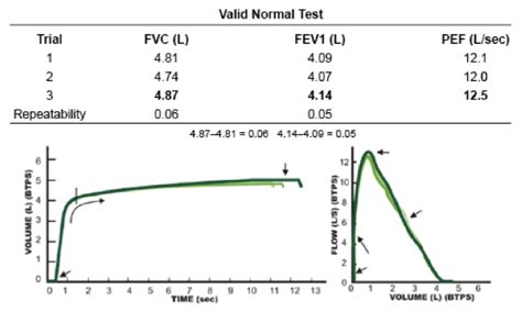 Spirometry Ekg Interpretation Ekgacademy