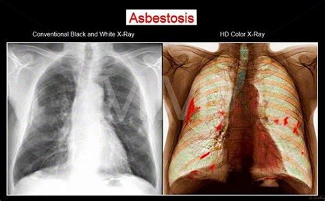 What Is Asbestosis Mesothelioma Law Firm Mesothelioma Basic Facts Litigation