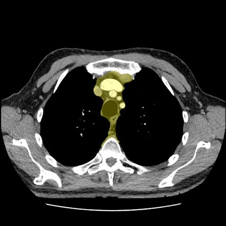 Superior Mediastinum Radiology Reference Article Radiopaedia Org