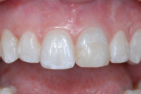 Images Of Crowns On Front Teeth - TeethWalls