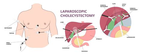 Laparoscopic Cholecystectomy For Gallbladder Removal Ace Specialist