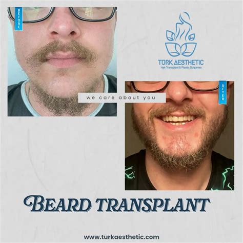 Beard Transplant Turk Aesthetic