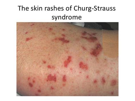 Syndrome De Churg Strauss Fmedic