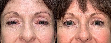 Ptosis Repair Archives Eyelid Center Of Utah