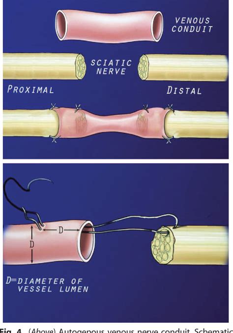 Figure 4 From Nerve Grafts And Conduits Semantic Scholar