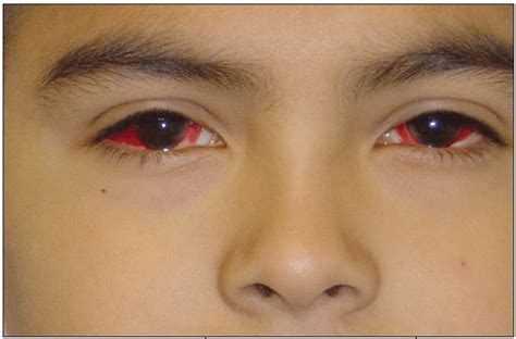 Traumatic Subconjunctival Hemorrhagecauses Symptoms And Treatment