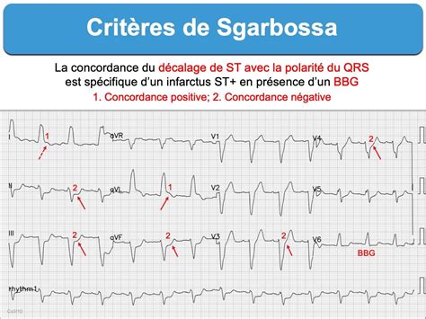 Critères de Sgarbossa e cardiogram