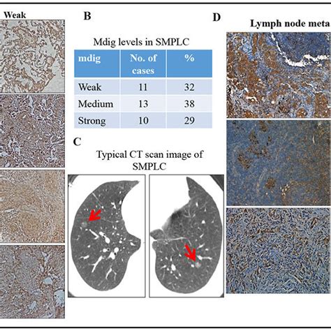 Variability In Mdig Expression In Smplc And Metastatic Lymph Nodes A