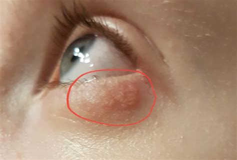 Ausschlag Unterm Auge Ursachen Symptome Behandlung Hebamme FZ