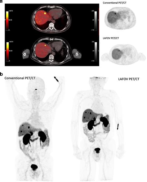 a Comparison of a ⁶⁸Ga DOTATOC study in a patient with liver