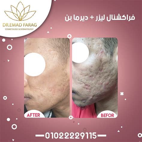 الفراكشنال ليزر افضل دكتور تجميل وليزر و جلدية في مصر دكتور عماد فرج