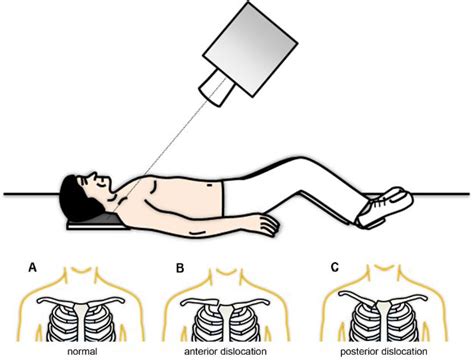 Sternoclavicular Joint Lump