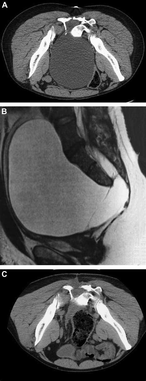 Huge Anterior Sacral Meningocele Simulating Bladder Retention Urology