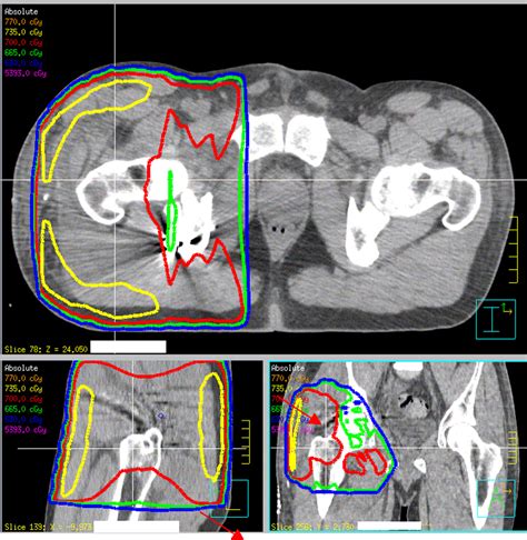 Figure 2 From Computerized Tomography Based Radiotherapy Improves