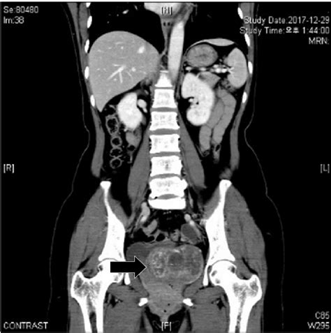 Abdominal Computed Tomography Showed An About 9 2 × 7 5 Cm Sized