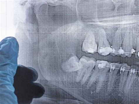 Wisdom Tooth Surgery Things To Know