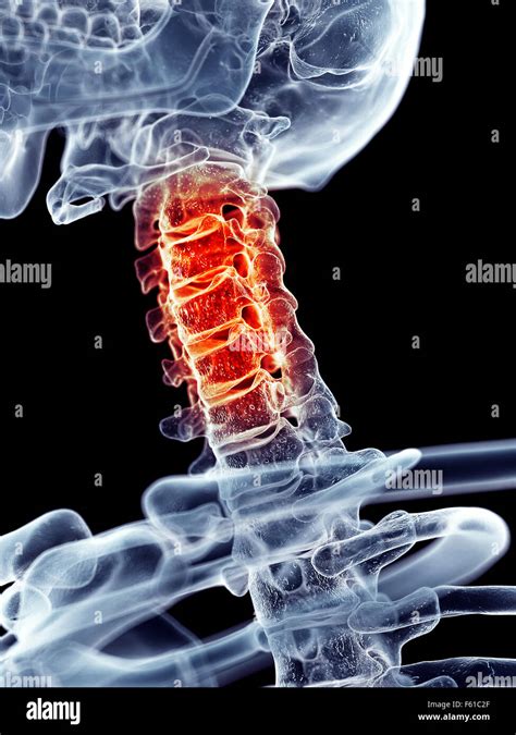 Medically Accurate Illustration Painful Cervical Spine Stock Photo