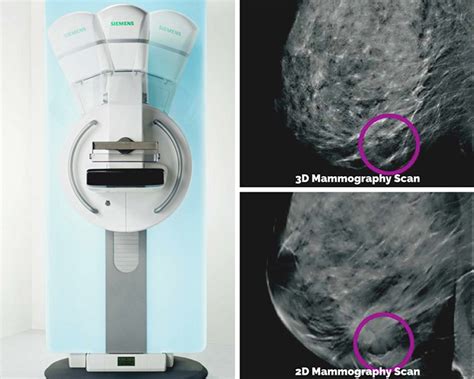 3d Mammography Available Soon In Gillette