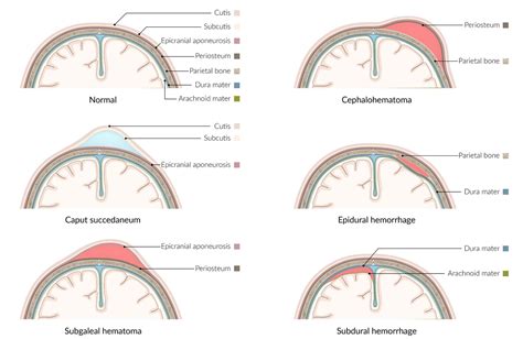 Cephalohematoma Versus Caput Succedaneum | NBKomputer