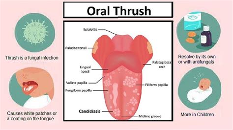 Thrush (Yeast infection): Causes and Treatment - Helal Medical