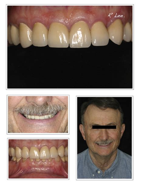 Full mouth reconstruction: Mr. JC – Dr. Roongkit Lee