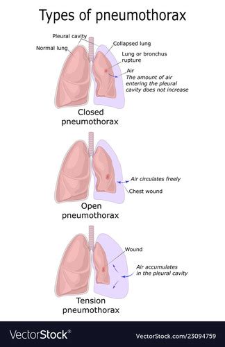 Exam Chest Trauma Pneumothorax Chest Tubes Flashcards Quizlet