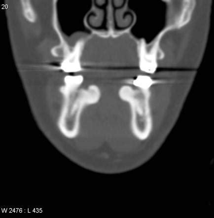 Mandibular tori | Radiology Reference Article | Radiopaedia.org