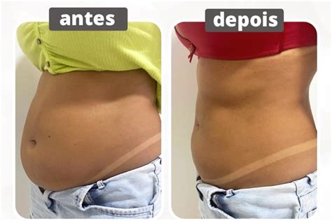 Lipo enzimática Antes e depois